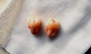 Хирургическое вмешательство по поводу кариозных зубов мудрости