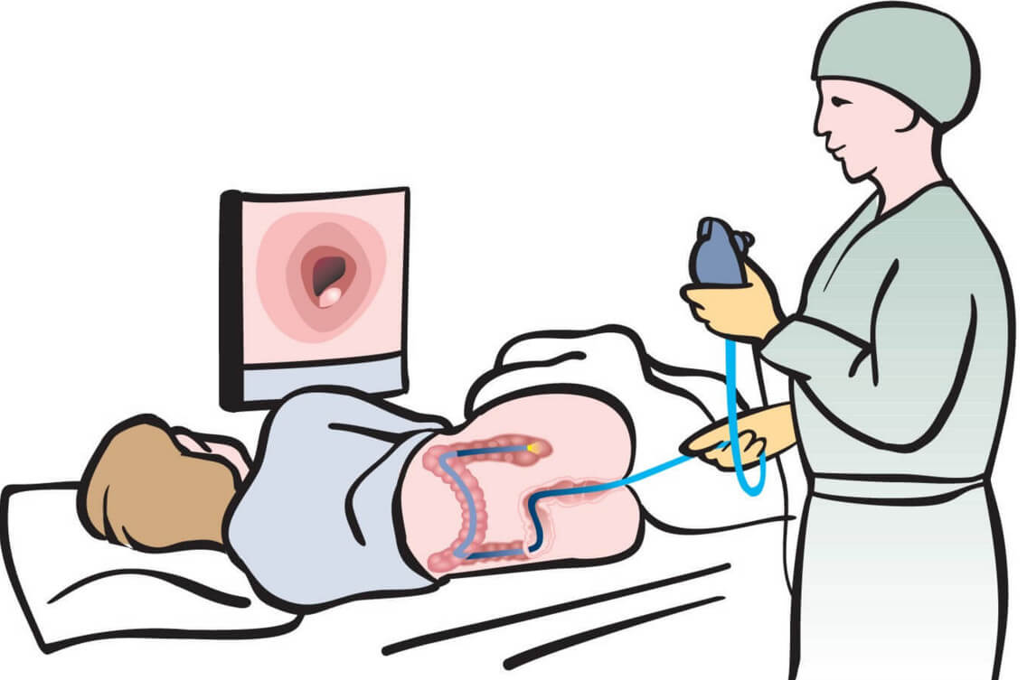 Подготовка пациента к колоноскопии: способы очищения кишечника