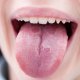 Трещины на языке: лечение, причины и симптомы