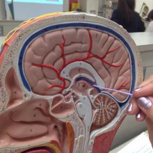 Киста гипофиза головного мозга, клиническая картина, причины и диагностика