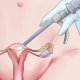 Удаление матки и яичников: последствия процедуры, плюсы и минусы операции